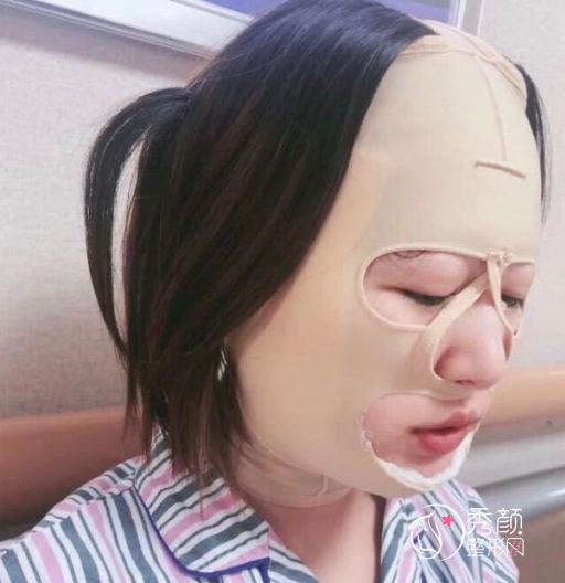 上海首尔丽格崔荣达磨骨口碑怎么样|附颧骨内推案例