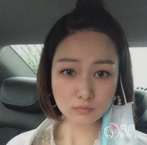 上海首尔丽格崔荣达磨骨口碑怎么样|附颧骨内推案例