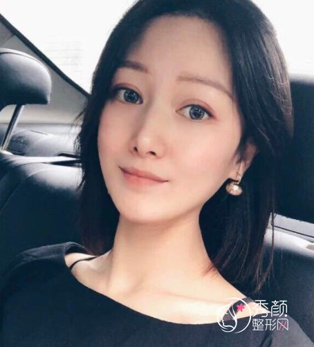 上海首尔丽格崔荣达磨骨口碑怎么样|附颧骨内推案例