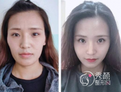 王自谦和邱立东谁做面部脂肪填充审美技术好|附面部脂肪填充案例