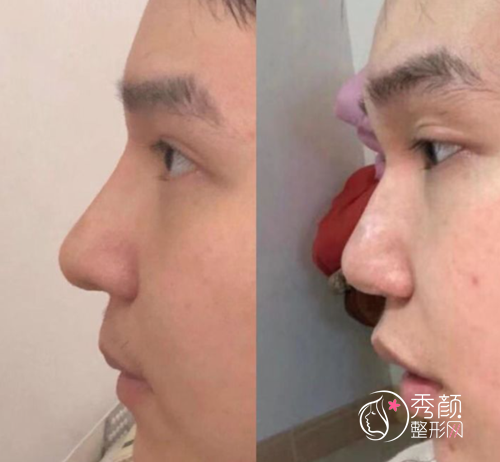 北京八大处隆鼻哪个医生好，八大处隆鼻医生案例技术特点对比。