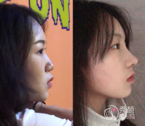 北京八大处隆鼻哪个医生好，八大处隆鼻医生案例技术特点对比。