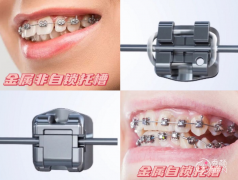 <b>金属自锁牙套怎么样，有什么优点和缺点？大概需要多少钱？</b>