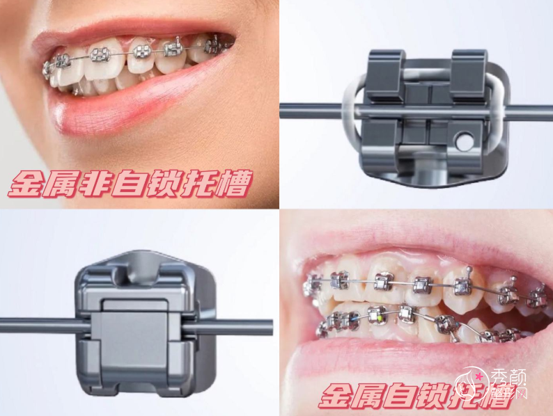 金属自锁牙套怎么样，有什么优点和缺点？大概需要多少钱？