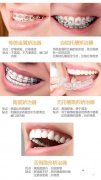 <b>牙套都有哪些类型，大概需要多少钱？</b>