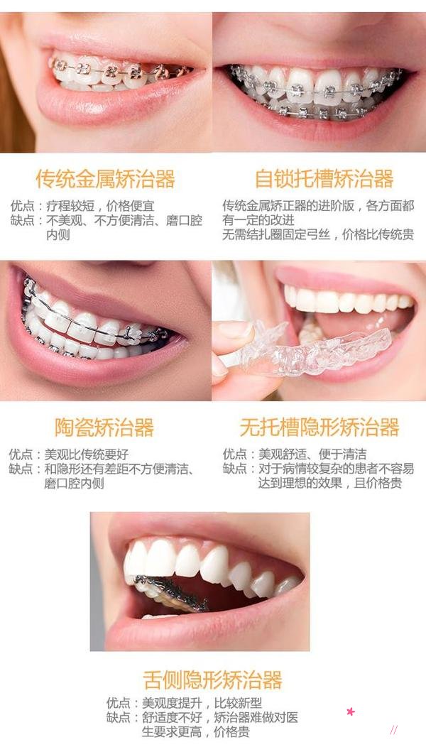 牙套都有哪些类型，大概需要多少钱？