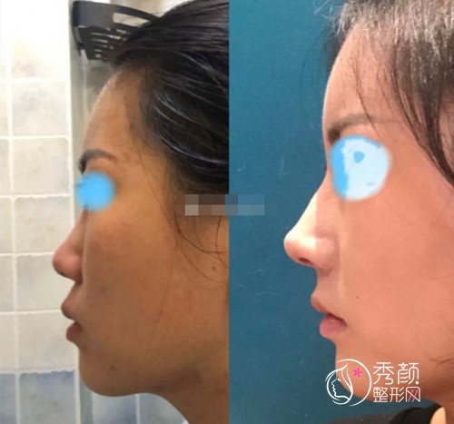 上海做鼻子哪个医生好,上海隆鼻医生风格技术整理|附隆鼻案例