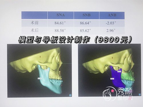 北大口腔王晓霞正颌手术经历分享给大家~