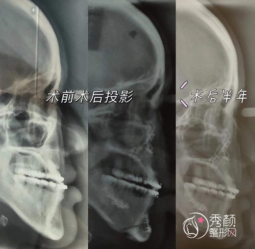 北大口腔王晓霞正颌手术经历分享给大家~