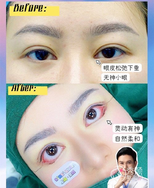 上海圣娅医疗美容医院魏少魁修复双眼皮怎么样|附双眼皮修复案例反馈