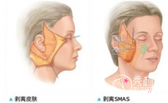 <b>大拉皮手术除皱能维持多久？大概多少钱？注意事项和风险。</b>