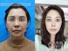 北京加减美v美拉皮面部提升到底好不好？附v美减龄案例反馈分享