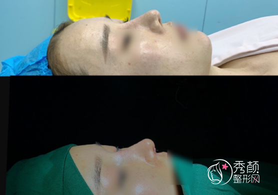 上海圣娅医院杨明肋骨鼻做的怎么样？附杨明鼻修复案例反馈分享。