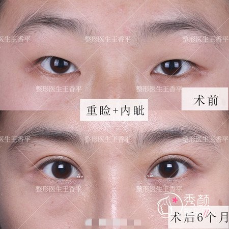 大连爱德丽格王香平双眼皮修复技术怎么样|附双眼皮案例反馈分享