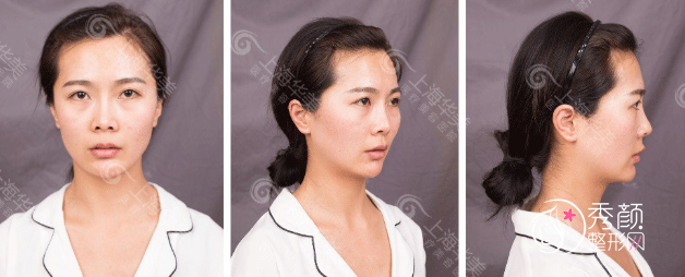 上海华美李健院长鼻部手术整形全过程案例分享!