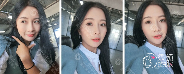 上海华美李健院长鼻部手术整形全过程案例分享!