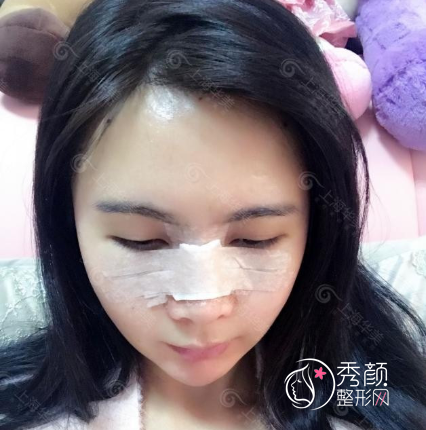 上海华美李健院长鼻部手术整形全过程案例分享！