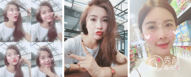 上海华美李健院长鼻部手术整形全过程案例分享!