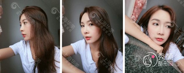 上海华美李健院长鼻部手术整形全过程案例分享!