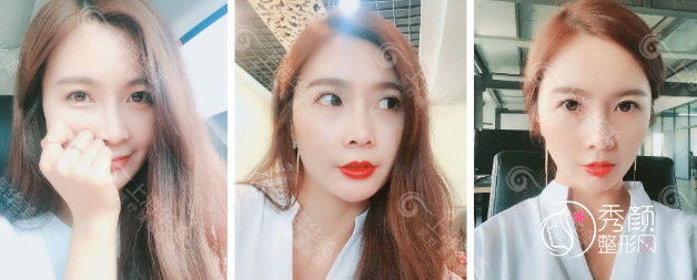 上海华美李健院长鼻部手术整形全过程案例分享!