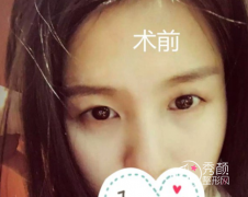 （沈阳）辽宁协和医院双眼皮怎么样，割双眼皮案例反馈分享。