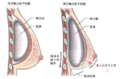 <b>假体隆胸都有哪些优点和后遗症！</b>
