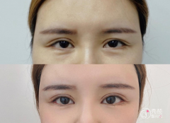 陈芝韩勋靳小雷刘风卓潘贰田国静王振军曾宪武朱晓峰哪个修复双眼皮好