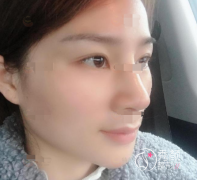 王艇鼻子做得怎么样？花80000元找王艇做了个鼻子来瞧瞧好不好！