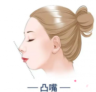 上海首尔丽格朴兴植院长凸嘴手术做得怎么样？