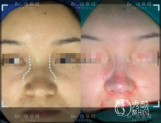 上海做网红鼻的隆鼻医生徐丽娟和赵鹏哪个好？技术审美口碑分析。