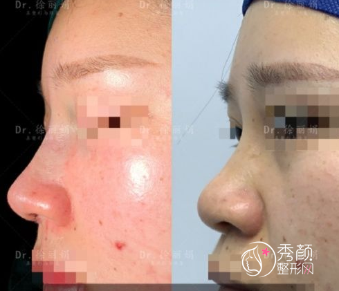 上海做网红鼻的隆鼻医生徐丽娟和赵鹏哪个好？技术审美口碑分析。