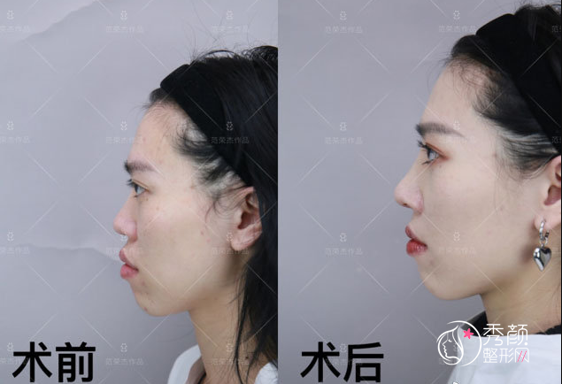 上海联合丽格范荣杰做鼻子怎么样|附范荣杰隆鼻案例