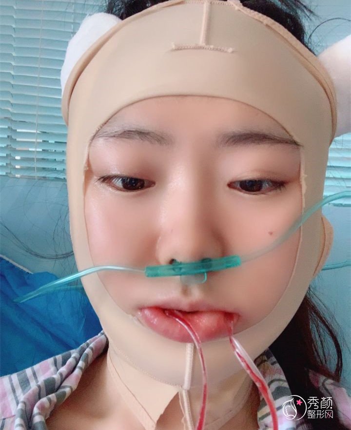 四川友谊医院面诊李继华，张立天后做的下颌角手术,看看做的怎么样！