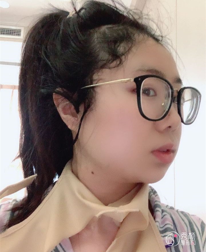 四川友谊医院面诊李继华，张立天后做的下颌角手术,看看做的怎么样！