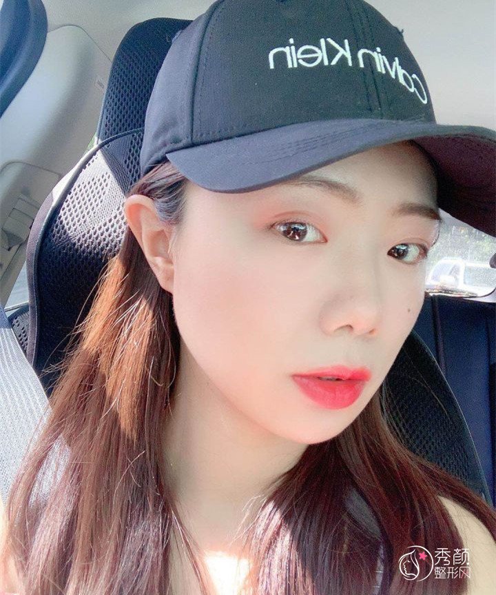 四川友谊医院面诊李继华，张立天后做的下颌角手术,看看做的怎么样！