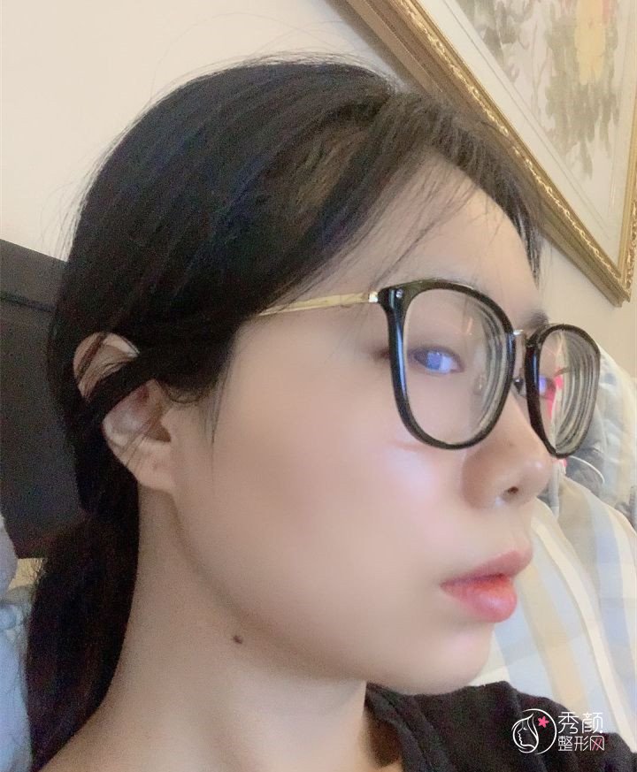 四川友谊医院面诊李继华，张立天后做的下颌角手术,看看做的怎么样！