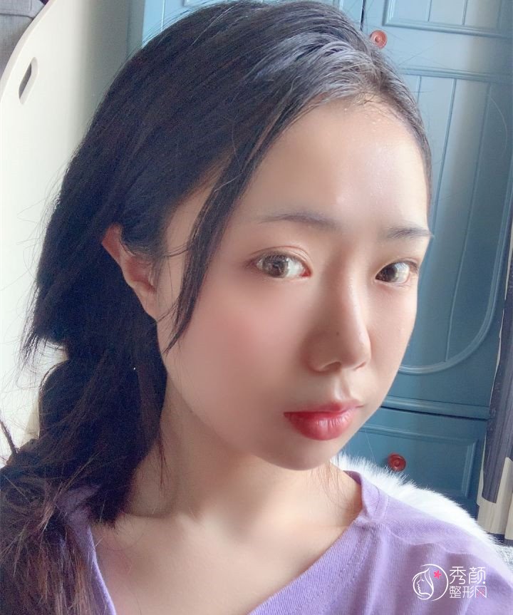 四川友谊医院面诊李继华，张立天后做的下颌角手术,看看做的怎么样！