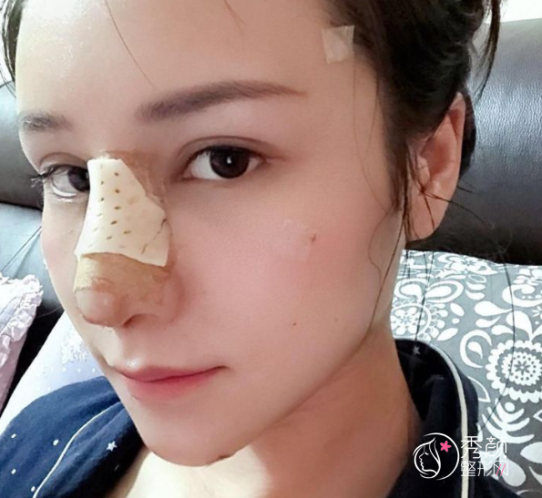 杭州李保锴做鼻子怎么样，花了68000元找李保锴做了初鼻！
