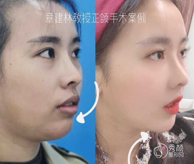 上海章建林正颌手术怎么样？附突嘴+龅牙矫正案例。