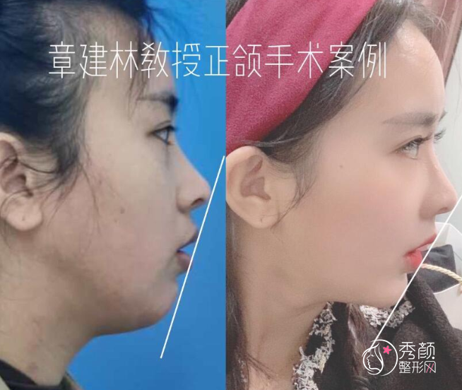 上海章建林正颌手术怎么样？附突嘴+龅牙矫正案例。