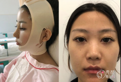 上海九院腰腹吸脂一般多少钱，附上海九院抽脂价格表！