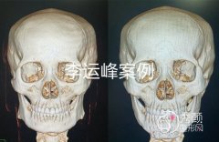 <b>成都磨骨李运峰、张立天和李继华谁做下颌角好一点？</b>