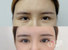 盘点北京双眼皮修复好医生,韩勋、王世勇、刘风卓到底哪个技术审美好？