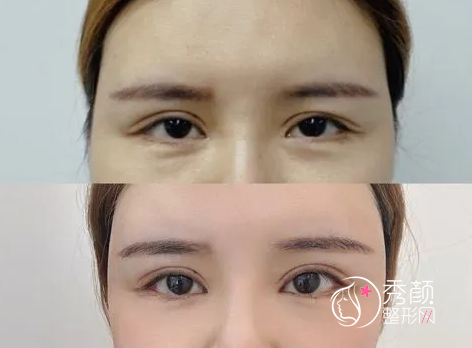 盘点北京双眼皮修复好医生,韩勋、王世勇、刘风卓到底哪个技术审美好？