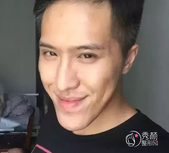 广东省口腔医院薛国初正颌手术怎么样|附正颌案例术前术后对比