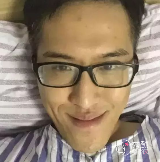 广东省口腔医院薛国初正颌手术怎么样|附正颌案例术前术后对比