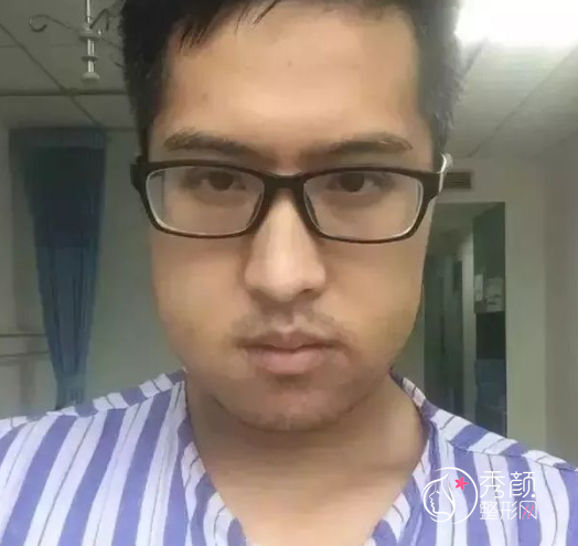 广东省口腔医院薛国初正颌手术怎么样|附正颌案例术前术后对比