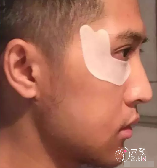 广东省口腔医院薛国初正颌手术怎么样|附正颌案例术前术后对比