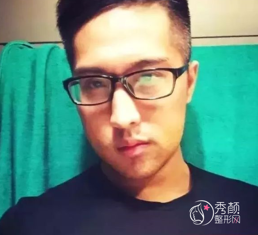 广东省口腔医院薛国初正颌手术怎么样|附正颌案例术前术后对比