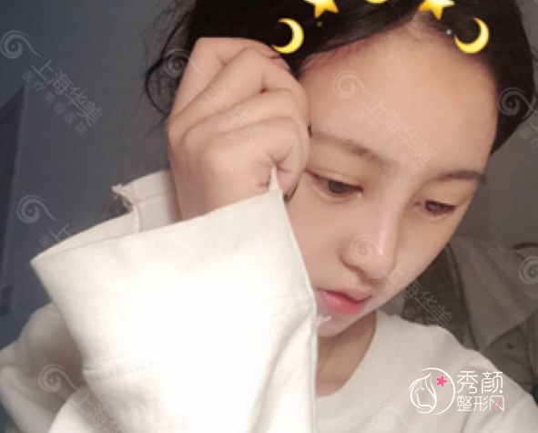 上海华美叶丽萍做鼻子怎么样，有没有失败案例？附叶丽萍隆鼻修复案例分享